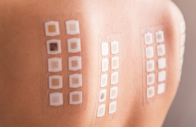 Understanding Patch Tests for Contact Dermatitis Diagnosis