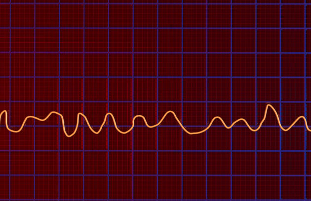 Ventricular Fibrillation: Understanding the Life-Threatening Cardiac Emergency